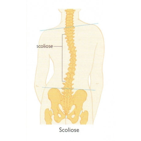 Spécial scoliose (exclusivement kiné et ostéo)